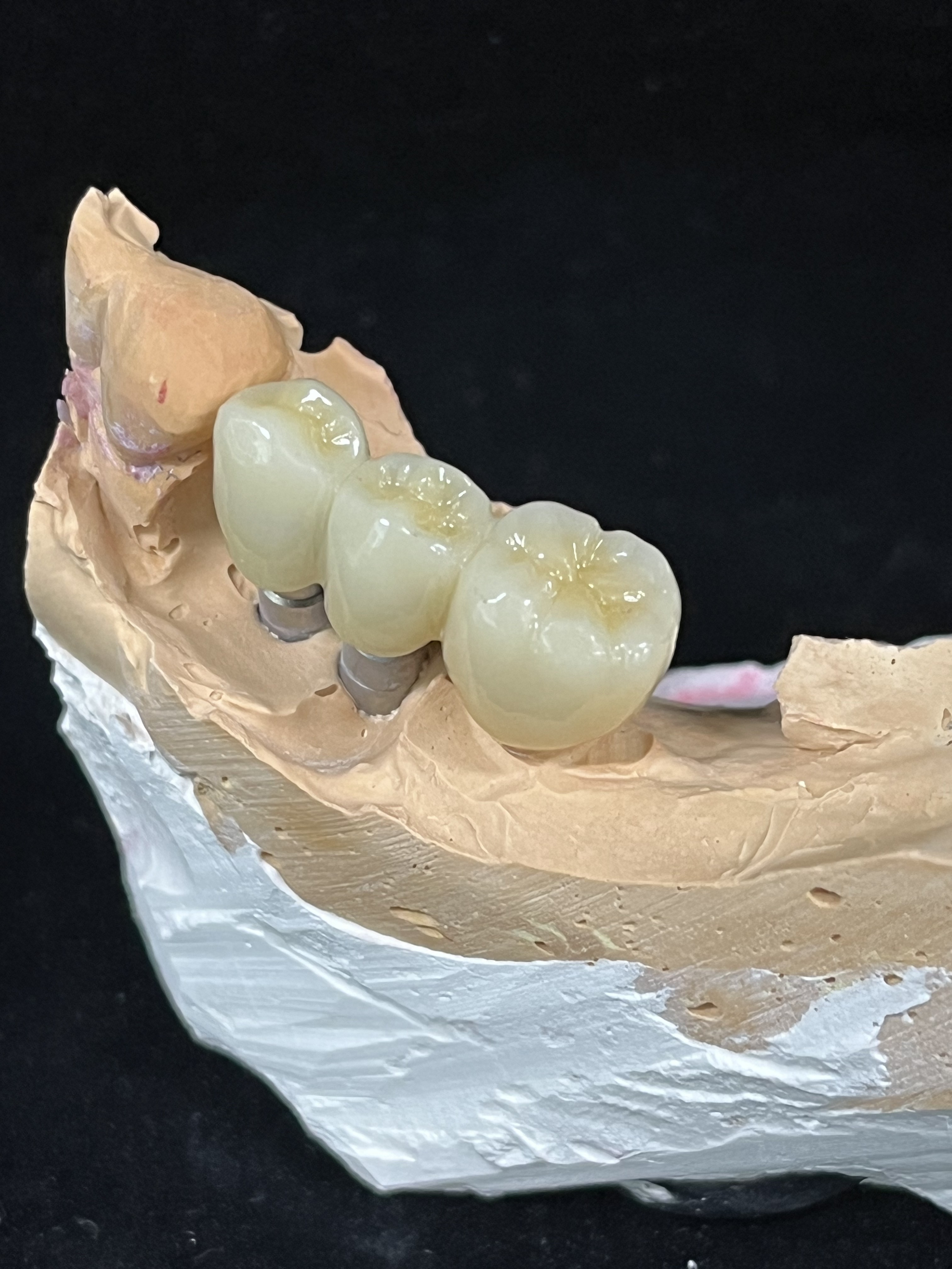 임플란트 브릿지
